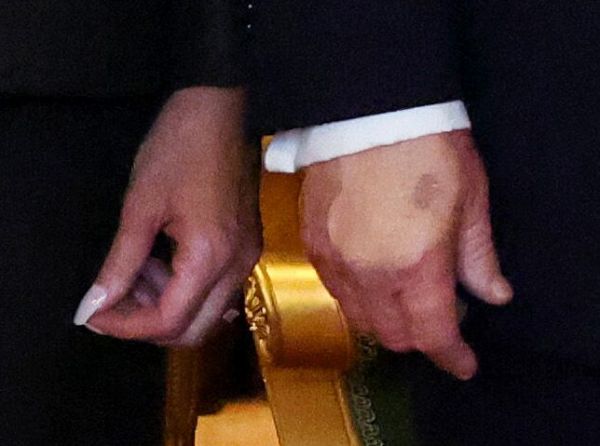 Пережил инсульт: названа вероятная причина слабоумия у Трампа